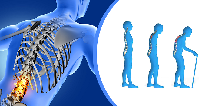 Osteoporosis - Medical Illustration Image.